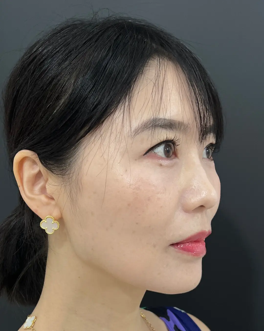 施術後